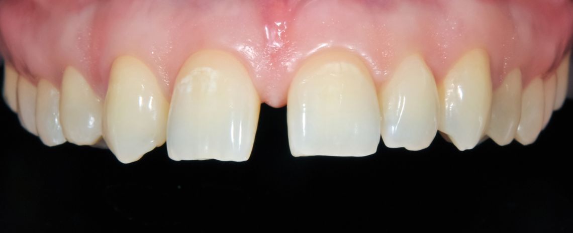 Teeth Straightening, Sculpting and Composite Bonding Before